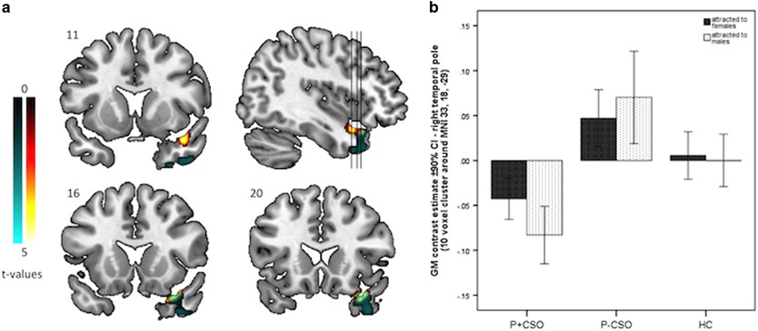 41398 2017 Article BFtp201796 Fig1 HTML 1eb79e695a142f0f
